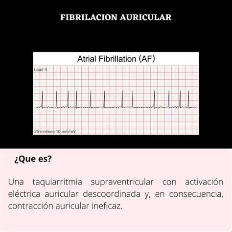 fibrilación auricular-4